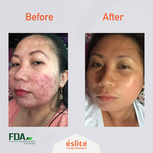 Load image into Gallery viewer, ESLITE S-Acetyl Glutathione with SOD Extract: Whitening and Anti-Aging